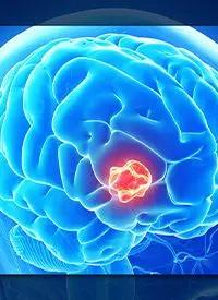 Glioblastoma |Image Credit: © Sebastian Kaulitzki - stock.adobe.com