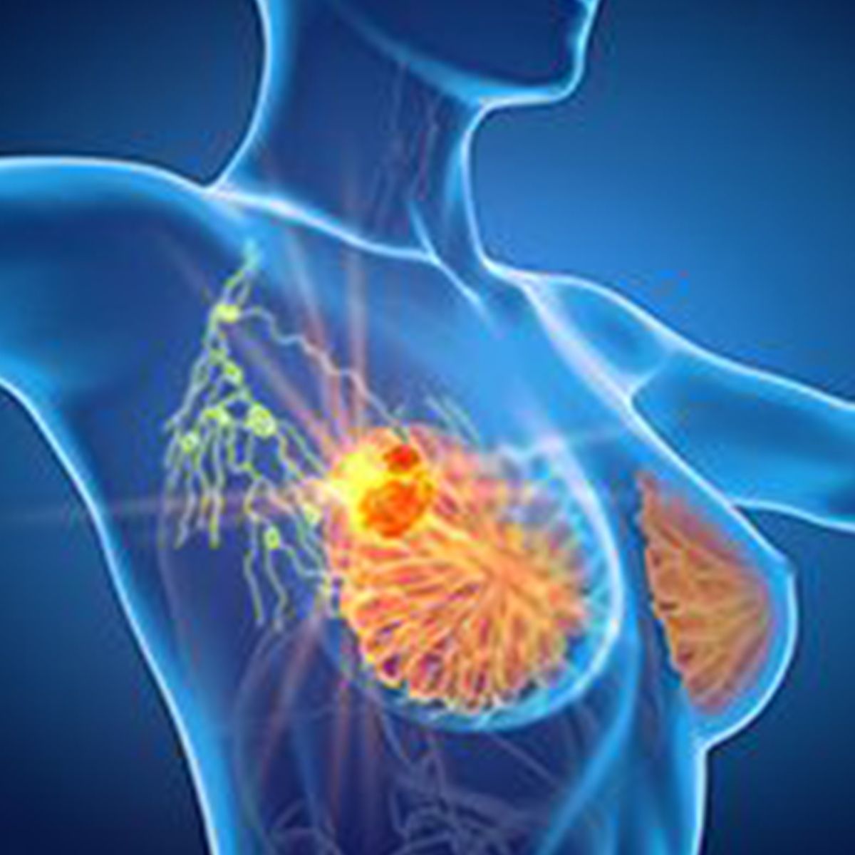 Elacestrant plus abemaciclib in  breast cancer | Image Credit: © Axel Kock - stock.adobe.com