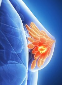 Breast Cancer | Image Credit:   © Sebastian Kaulitzki - stock.adobe.com