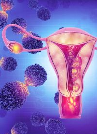 Advanced Cervical Cancer | Image credit:  © Crystal light - stock.adobe.com