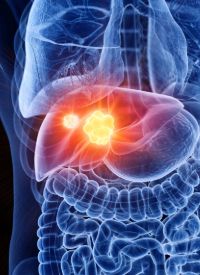 Hepatocellular Carcinoma |  Image Credit: © Sebastian  Kaulitzki - stock.adobe.com