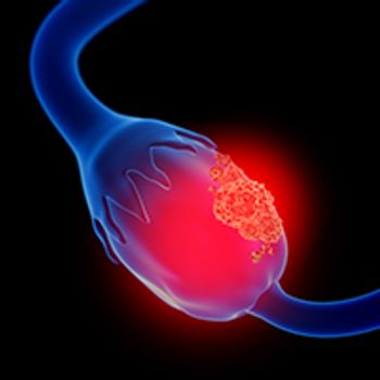 3d illustration of ovarian cancer | Image Credit: © Lars Neumann - stock.adobe.com