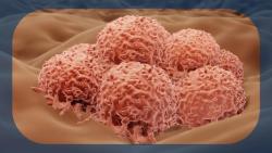 Padeliporfin Vascular Targeted Photodynamic Therapy Safely Produces High Response Rates in Low-Grade Upper Tract Urothelial Cancer