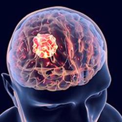 MAGIC-G1 Study Provides Updated Findings With MTX110 in Recurrent Glioblastoma