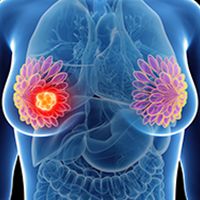 Breast Cancer Image