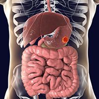 Liver cancer