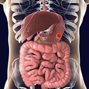Liver cancer