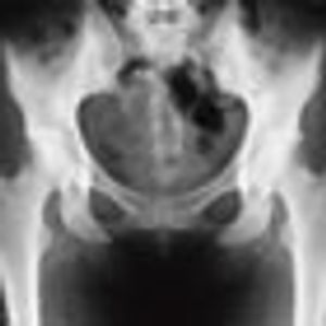 Bone Health Programs in Urology Practices Deliver Continuity of Care