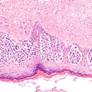 Immunotherapy Resistance in Uveal Melanoma | Image Credit: © David A Litman - stock.adobe.com
