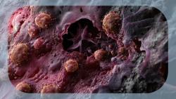 Sarilumab Plus Ipilimumab, Nivolumab, and Relatlimab Displays High Response Rate in Unresectable Melanoma
