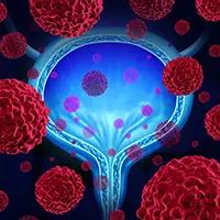 urothelial cancer | Image Credit: © freshidea - stock.adobe.com