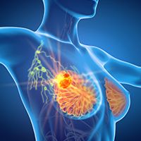 T-DXd in HER2+ Metastatic Breast Cancer | Image Credit: © Axel Kock - stock.adobe.com