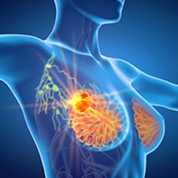 T-DXd Maintains Survival Advantage Over Physician’s Choice of Therapy in HER2+ Metastatic Breast Cancer