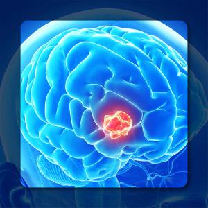 Glioblastoma |Image Credit: ©   Sebastian Kaulitzki - stock.adobe.com