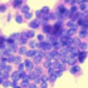 Blanket Approach to RAI in PTC Patients May Not Be Necessary