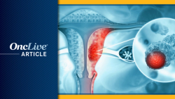 WES-Aneuploidy Scores May Be Prognostic for Immunotherapy in dMMR Endometrial Cancer