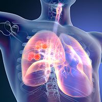Non-small cell lung cancer 