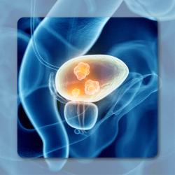 Sacituzumab Govitecan Does Not Significantly Improve OS in Pretreated Urothelial Carcinoma