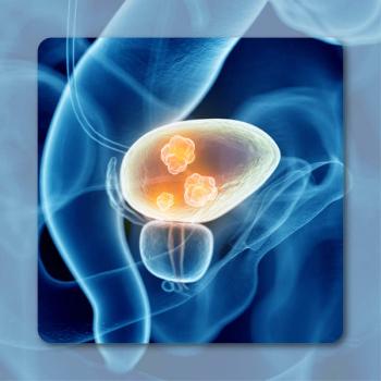 Urothelial Carcinoma | Image Credit: © Sebastian Kaulitzki- stock.adobe.com