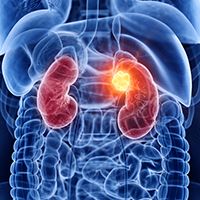 Metastatic Clear Cell RCC Subsets | Image Credit: © SciePro - stock.adobe.com