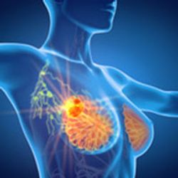 Atezolizumab Does Not Improve pCR in HER2-Positive Early Breast Cancer