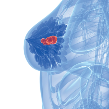 breast cancer