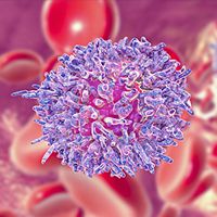 Among patients with newly diagnosed high-risk multiple myeloma, treatment with BCMA/CD19 dual-targeting FasTCAR-T Cells resulted in an overall response rate of 100%, with all treated patients evaluable for minimal residual disease showing minimal residual disease negativity to 12 months.