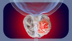 Darolutamide Plus ADT Earns Positive Opinion for European Approval From CHMP in Metastatic Hormone-Sensitive Prostate Cancer
