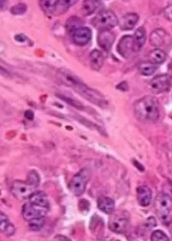 Gastrointestinal Stromal Tumor