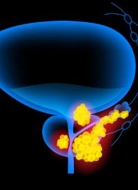Niraparib/Abiraterone in HRR+ Metastatic Castration-Sensitive Prostate Cancer | Image Credit: © pikovit - stock.adobe.com