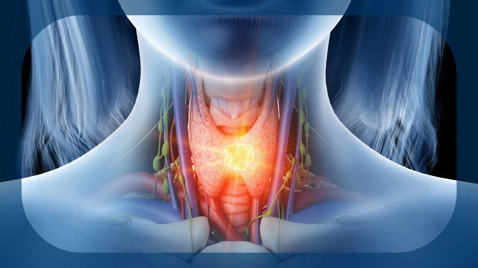 Oropharyngeal Squamous Cell Carcinoma |  Image credit: © Sebastian Kaulitzki - stock.adobe.com