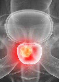 Darolutamide Plus ADT in Metastatic Hormone-Sensitive Prostate Cancer | Image Credit: © Sebastian Kaulitzki - stock.adobe.com