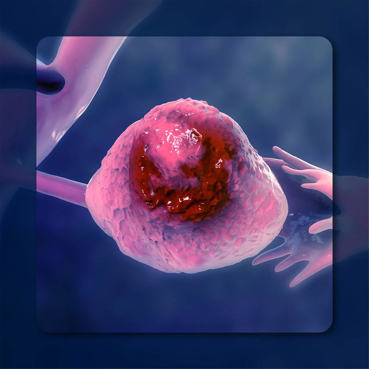 Ovarian Cancer |  Image Credit: © Katsyarina – stock.adobe.com