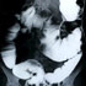 Three-Year Imatinib Regimen Delivers Optimal GIST Treatment