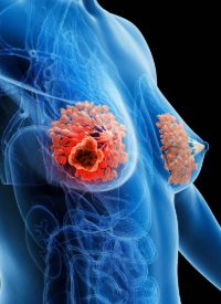 健康・医学 Breast Cancer Trastuzumab Deruxtecan Maintains Durable QOL in HER2+ Breast