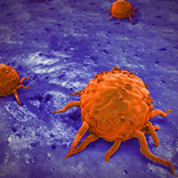 testicular cancer