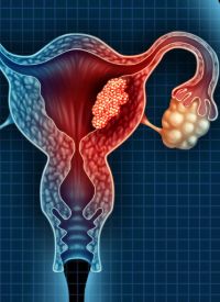 Cervical Cancer | Image Credit: © freshidea - stock.adobe.com