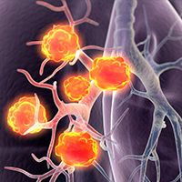lung cancer