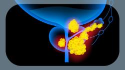Enzalutamide Plus Leuprolide Yields OS Benefit in nmHSPC With Biochemical Recurrence