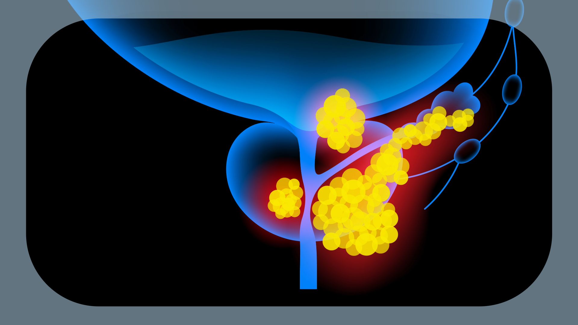 Enzalutamide Plus Leuprolide Yields OS Benefit in nmHSPC With Biochemical Recurrence