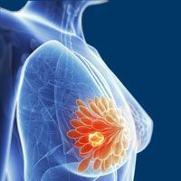 Real-world Data Confirm Safety Profile for Tucatinib Plus Trastuzumab/Capecitabine in HER2+ Breast Cancer