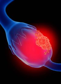 Epithelial Ovarian Cancer | Image credit:   © Sebastian Kaulitzki - stock.adobe.com