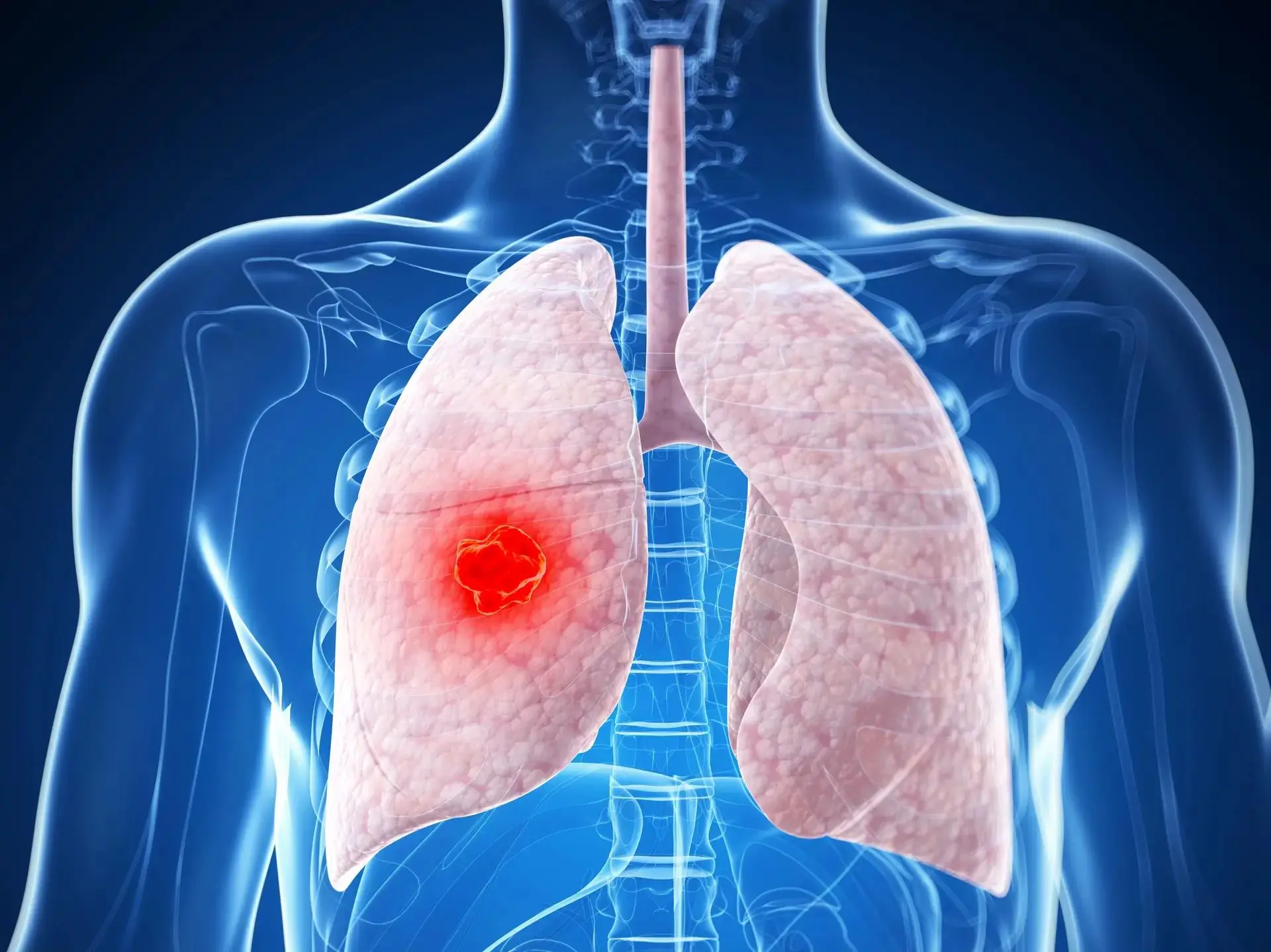 Updates from ASCO 2025 in Advanced Non‒Small Cell Lung Cancer