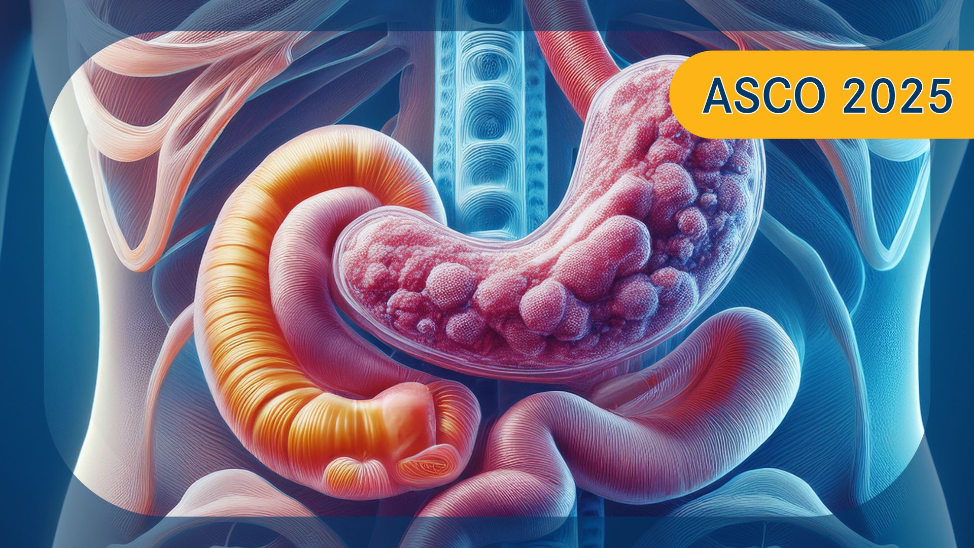 Gastric/GEJ Adenocarcinoma | Image Credit: © Ashling Wahner &  MJH Life Sciences Using AI