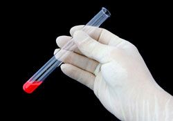 PSA Screening