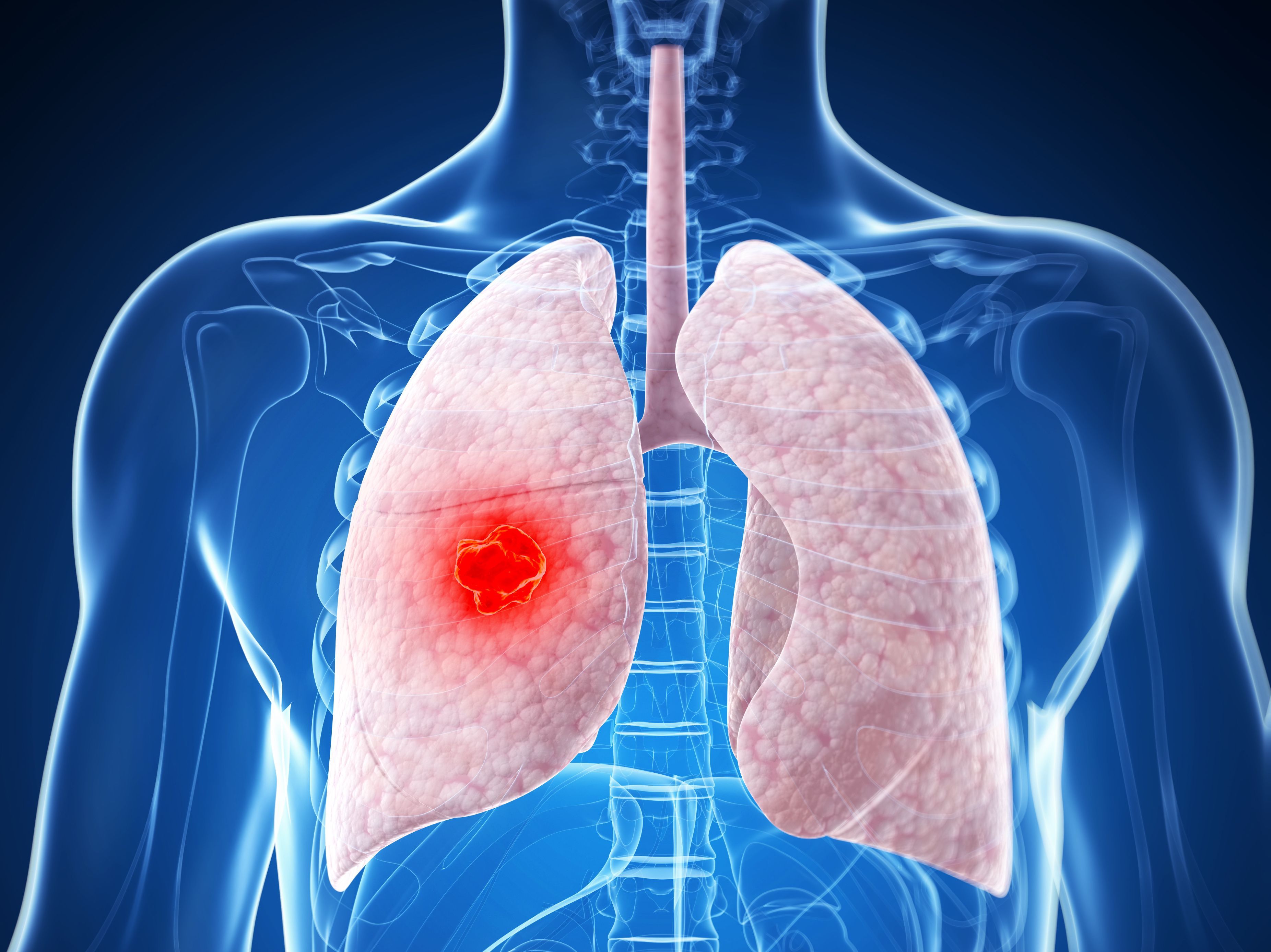 Integrating Novel Approaches to HER2-Mutated NSCLC Management