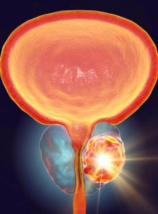 Outlining the Evolving Efficacy and QOL Outcomes Associated With ADT in Prostate Cancer