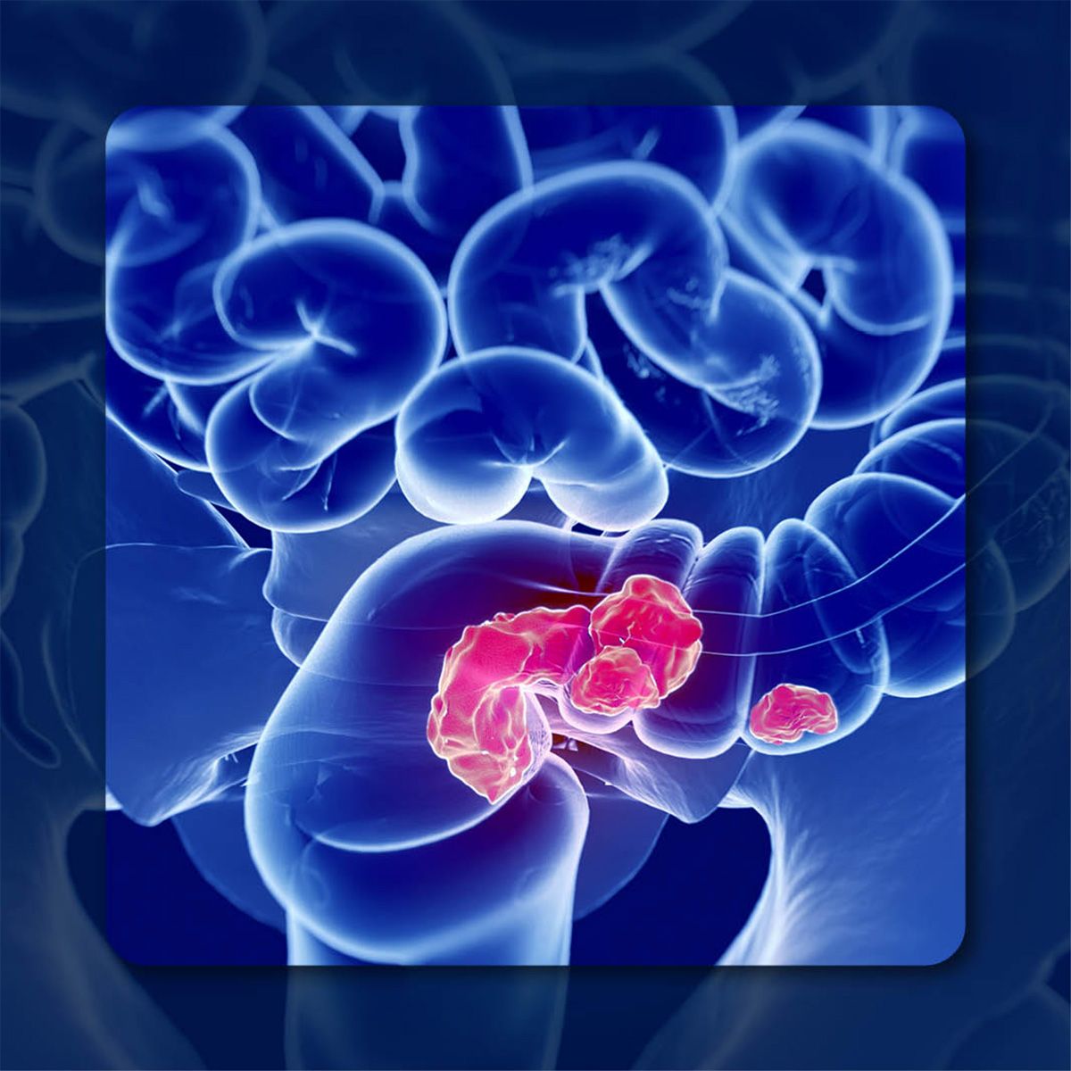 mCRC | Image Credit:   © Sebastian Kaulitzki – stock.adobe.com