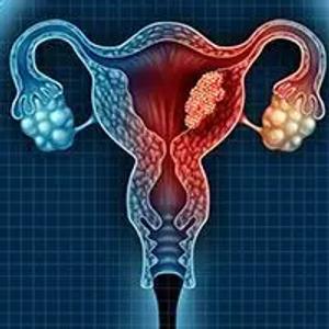 Immunotherapy Approvals Signal a Need for Molecular Testing in Endometrial Cancer