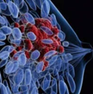 Greater Adherence to a Diet for Diabetes Reduction May Improve Survival for Breast Cancer